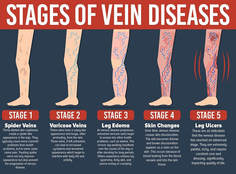 what-are-varicose-veins